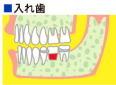 インプラン5